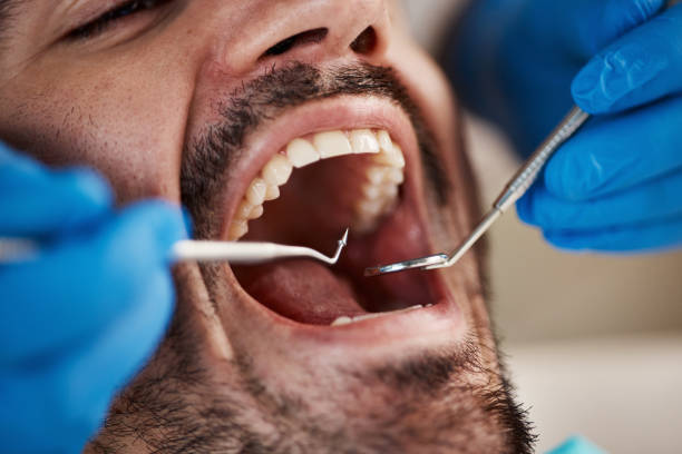 Best Emergency Wisdom Teeth Removal in Phillipsburg, GA
